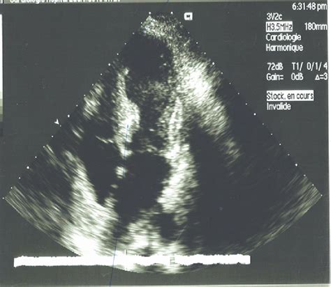 hypokinesis of the apex